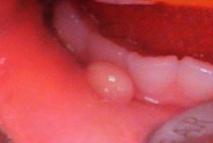 やけど 口 の 中 口の中が痛い・ヒリヒリする。口内炎やカンジダ症の原因や治療法【歯科口腔外科医監修】